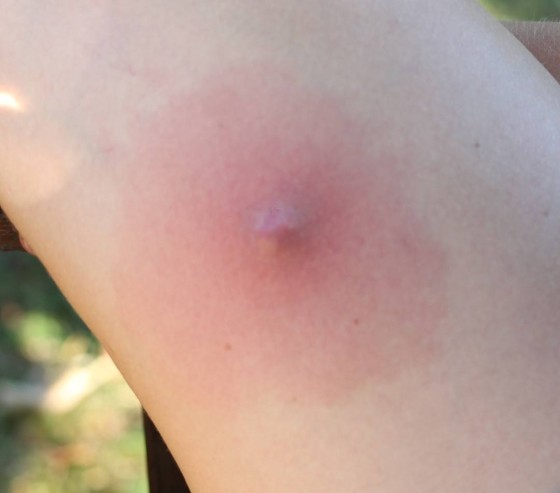 atherom_bilder_2