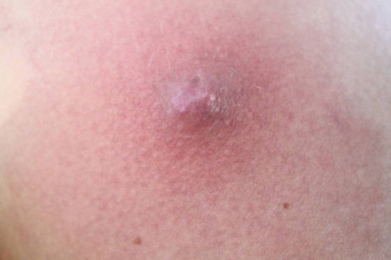 atherom_bilder_5